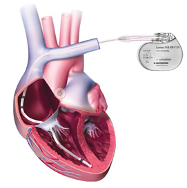 Biotronik Lumax 740 DX System