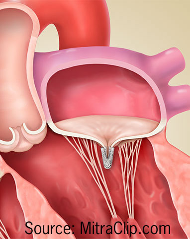 Image of a mitral valve repair with MitraClip